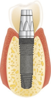 Implantaat voor bijplaatsen één of meerdere tanden of kiezen